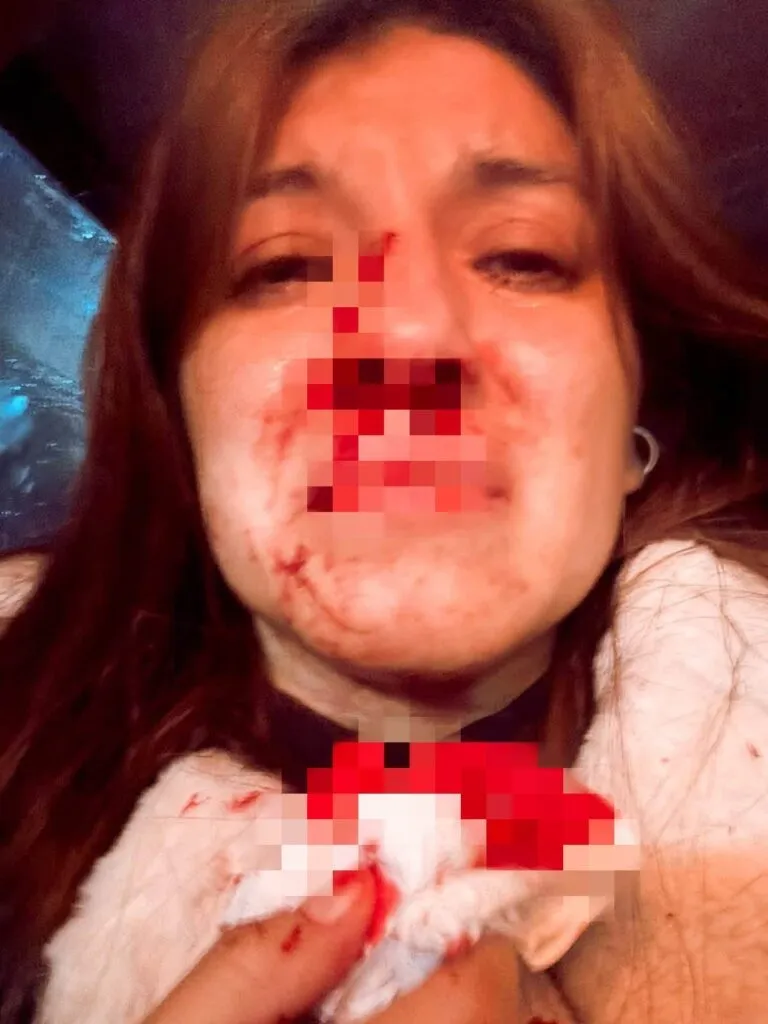 Pasajera denuncia fractura de nariz tras altercado entre choferes de combis en Pachuca
