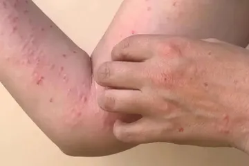 OMS declara brote de mpox como emergencia de salud pública internacional