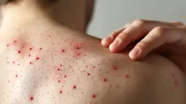 Casos de Sarampión en Hidalgo