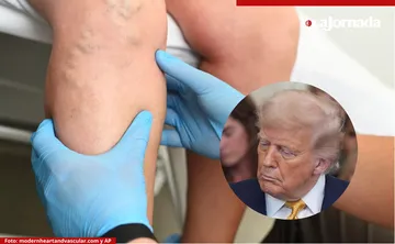 ¿Qué es la insuficiencia venosa crónica, la afección diagnosticada a Donald Trump?