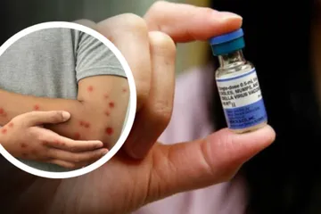Hidalgo sin casos de sarampión, pero Secretaría de Salud pide vacunarse