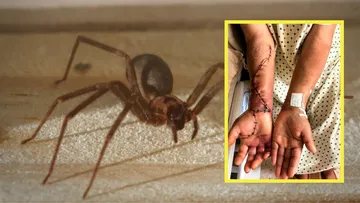 paciente tras mordedura de araña violinista.