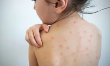 Salud confirma diez casos de sarampión en Hidalgo