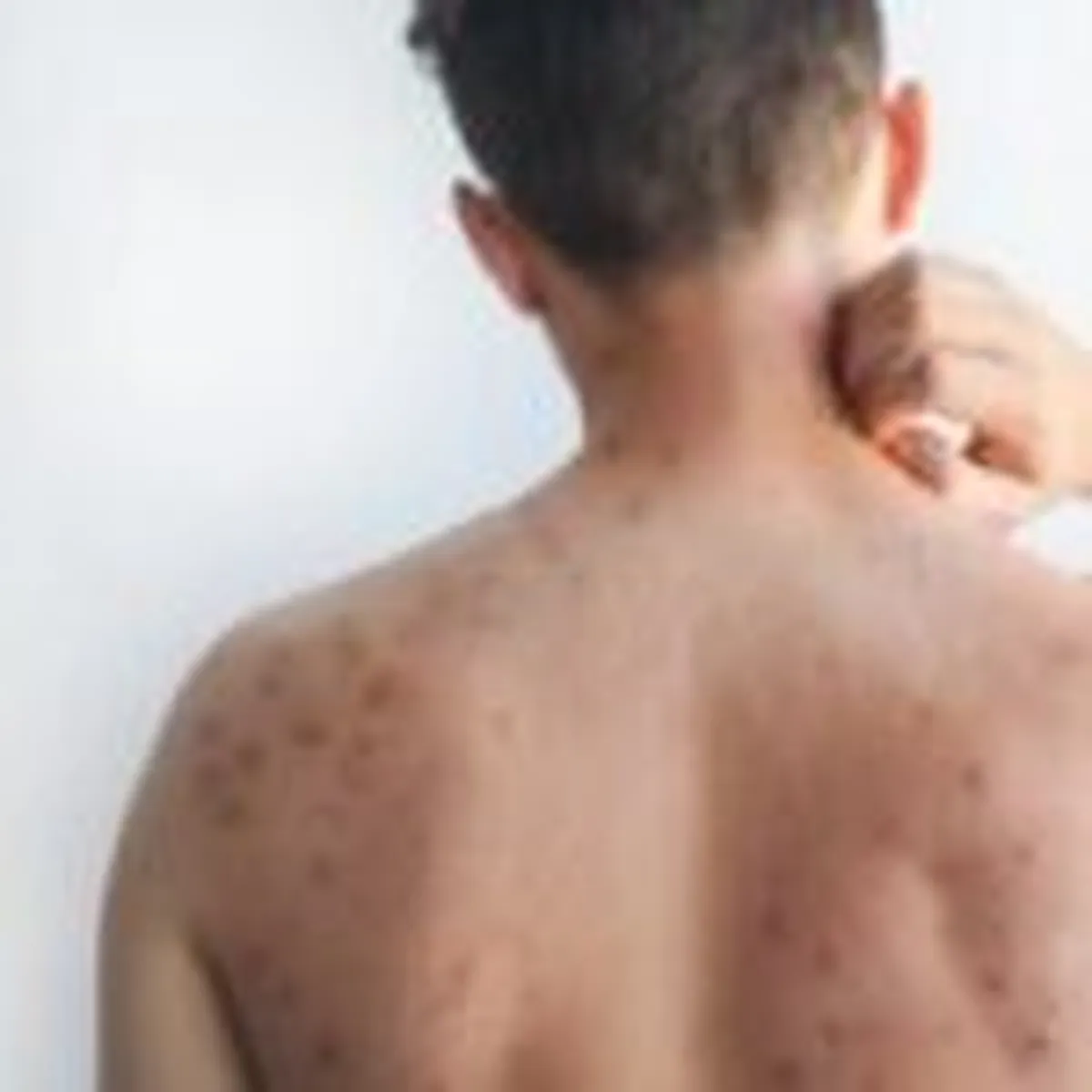 Casos de Sarampión en Hidalgo