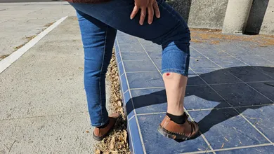 Periodista lesionada