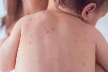 Sin sarampión en Hidalgo, pero suben los contagios de varicela