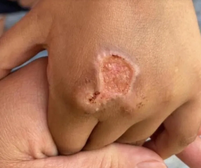 ¡Terrible! Queman manitas a niños de 4 y 6 años en Edomex; madre y padrastro actuaron en complicidad