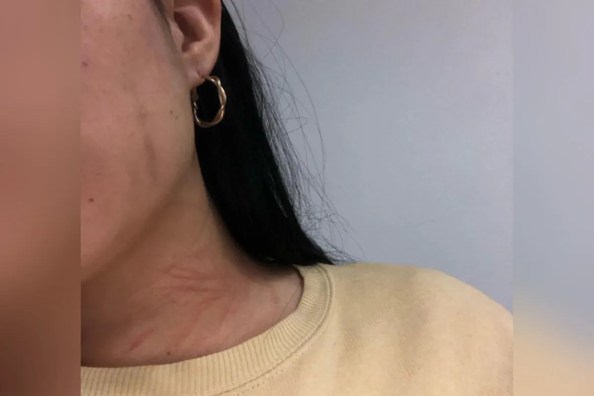 Pachuca: Joven denuncia violencia por parte de su pareja