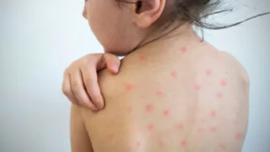 Salud confirma diez casos de sarampión en Hidalgo