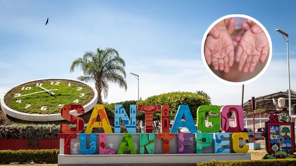 santiago tulantepec sarampion