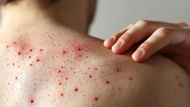 Confirman primer caso de sarampión en Hidalgo; piden reforzar vacunación infantil