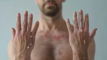 Hombre contagiado con viruela símica