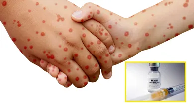 Personas contagiadas de sarampión y la vacuna