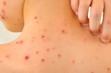 Contribuye el estrés crónico a la aparición del virus herpes zóster