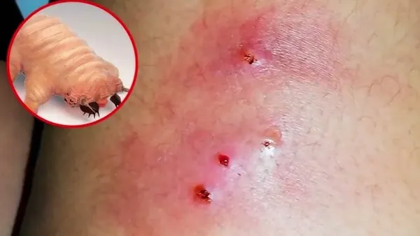 Detectan primer caso y activan protocolos en Hidalgo