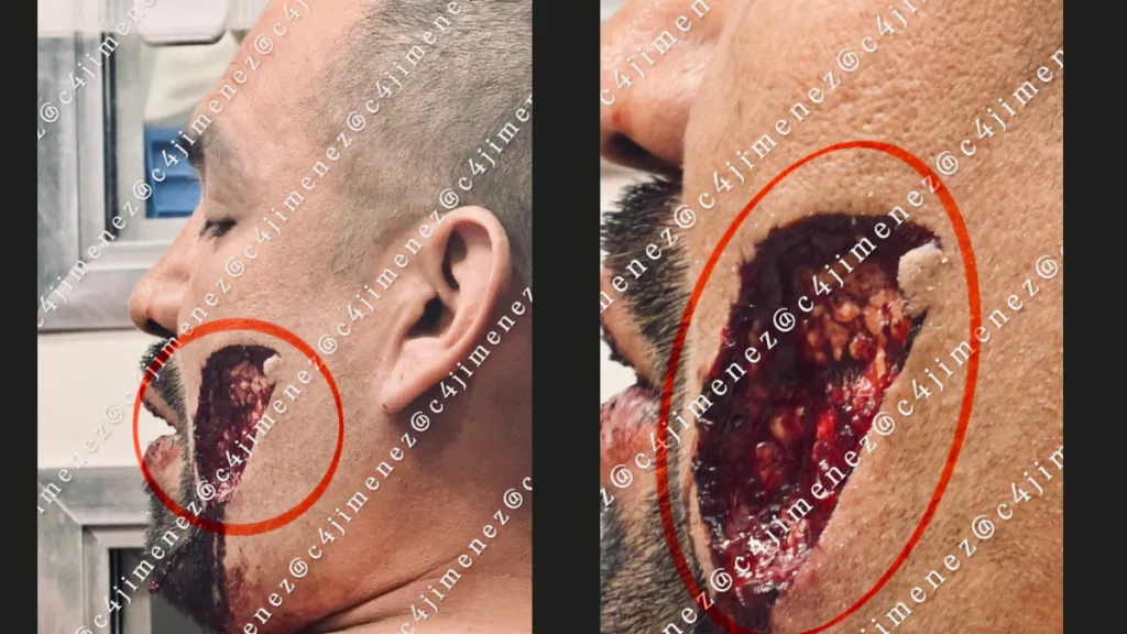 Imágenes sensibles | Intentó agredir sexualmente a una mujer y termina con parte del cachete arrancado en CDMX