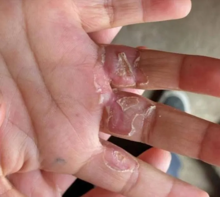 ¡Terrible! Queman manitas a niños de 4 y 6 años en Edomex; madre y padrastro actuaron en complicidad