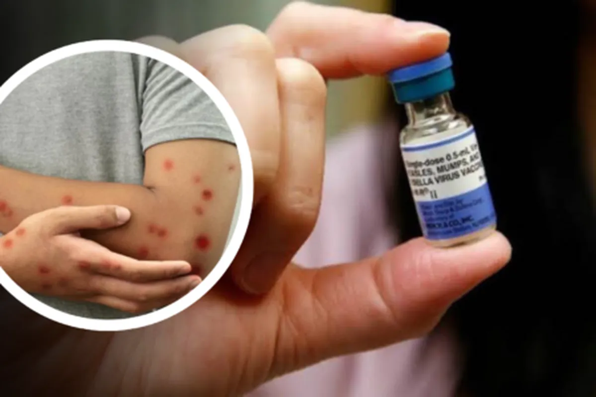 Hidalgo sin casos de sarampión, pero Secretaría de Salud pide vacunarse