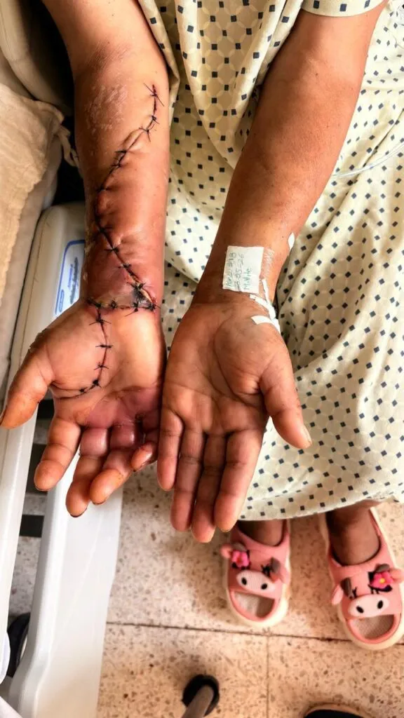 ¡Araña violinista casi le cuesta un brazo! Médicos de Apan lograron salvarlo