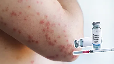 Personal de salud aplica vacuna contra el sarampión