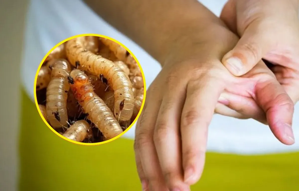 Primer caso de gusano barrenador en humanos en Hidalgo es señal de alarma; llaman a proteger heridas
