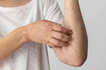 Viruela del mono: OMS cambia el nombre de la enfermedad por “mpox”