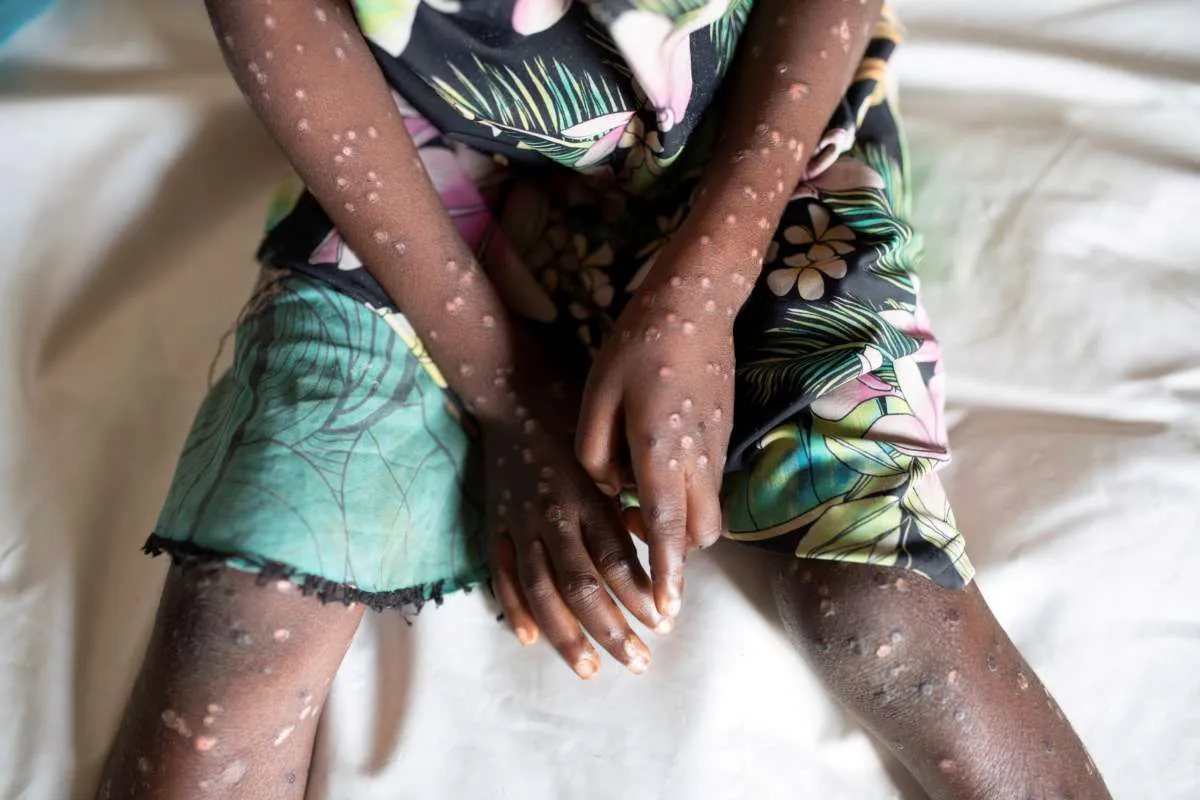 Reportan en Suecia primer caso de mpox fuera de África