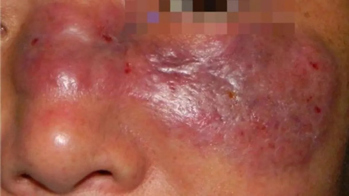 ¿Qué es el hongo negro?