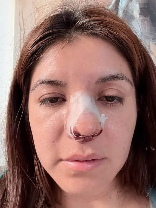 Pasajera denuncia fractura de nariz tras altercado entre choferes de combis en Pachuca